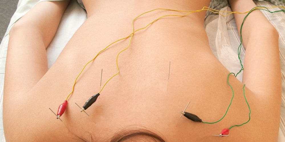 Electrodes are connected to acupuncture needles in a female patient's back for electrical stimulation therapy.